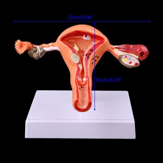 ❤❤ Pathological Uterus Ovary Anatomical Model Anatomy Cross Section Study Tool DRCF