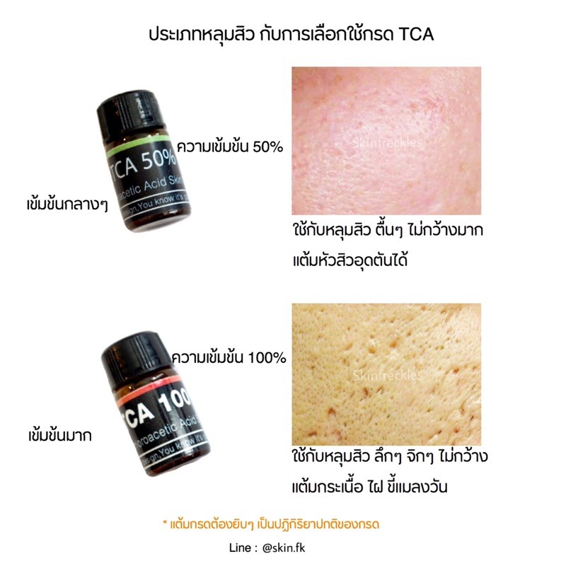 แต้มหลุมสิว แต้มกระเนื้อ