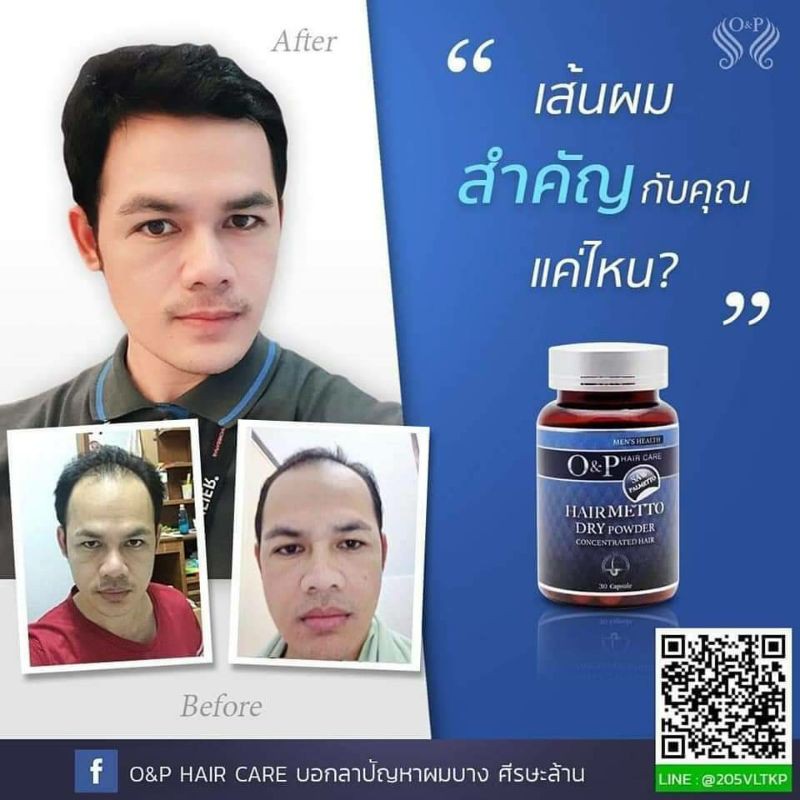 Op Herrmetto(สำหรับผู้ชาย) รักษาผมร่วงผมบางศีรษะล้าน - Pirunberkban -  Thaipick