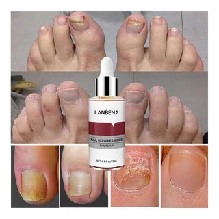 Lanbena เซรั่มเอสเซ้นบํารุงเล็บ กําจัดเชื้อราที่เล็บ 15 มล.