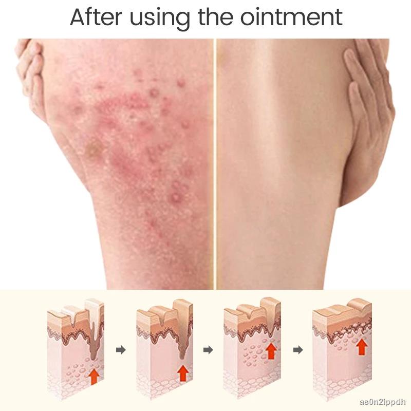 Pikangwang Antibacterial Cream Athlete39s Foot Cream Herbal Treatment ...