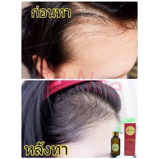 เห็นผลจริง!! เซรั่มปลูกผมRanee Hair Serum แบบลูกปัดและลูกกลิ้ง ขนาด 15 ml. เซรั่มปลูกผม ไรผม คิ้ว เครา หนวด