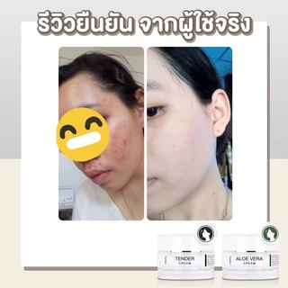เซตรักษาสิว รอยสิว เพิ่มความชุ่มชื้น