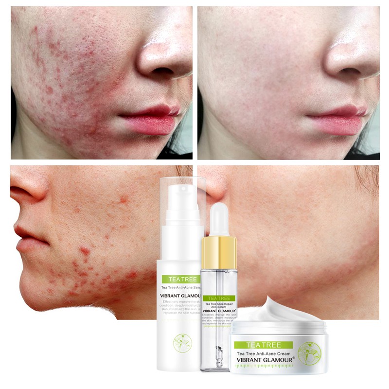 acne ser