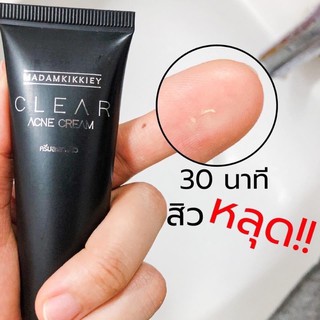 ครีมละลายสิว (ผด,อุดตันหัวขาว-หัวดำ,สิวเสี้ยน) ของแท้ พร้อมส่ง