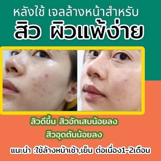 Acne Pearl เจล ล้างลดสิว pH5.5 Salicylic เหมาะคนเป็นสิว คุมมัน สิวอุดตัน สิวอักเสบ สิวผด ลดสิว สิวหาย