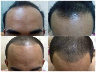 📣Witch Hair เซรั่มปลูกผม คิ้ว หนวด ขวดแรกเห็นผล💯% ขนาด 60ml.