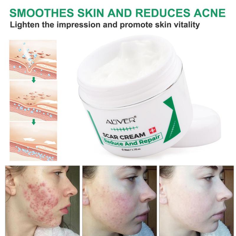 Scar Removal Cream Acne Treatment Repairing Scar Body Slimming Cream Whitening Moisturizing Skin Care 97g TSLM1