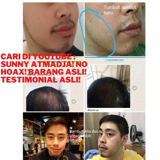 finasteride and minoxidil price