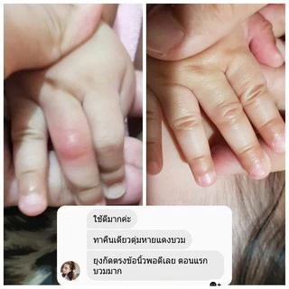 แพ็คคู่ บาล์มออร์แกนิค USDA ขนาด 15g. สำหรับเด็ก 3 เดือนขึ้นไป ทาหลังยุงกัด | ING Organic