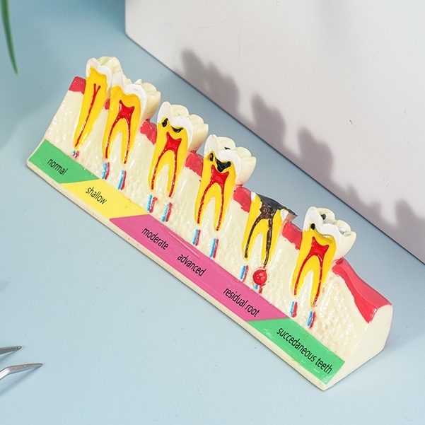 โมเดลฟันผุ วิวัฒนาการ วิเคราะห์ฟันผุ สําหรับสอนการสาธิตฟัน