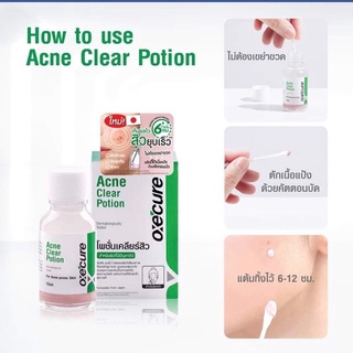 OXECURE Acne Clear Potion 15ml. อ๊อกซีเคียว แอคเน่ เคลียร์ โพชั่น ลดสิว แต้มสิวอักเสบ แต้มสิวยุบ6ชม.