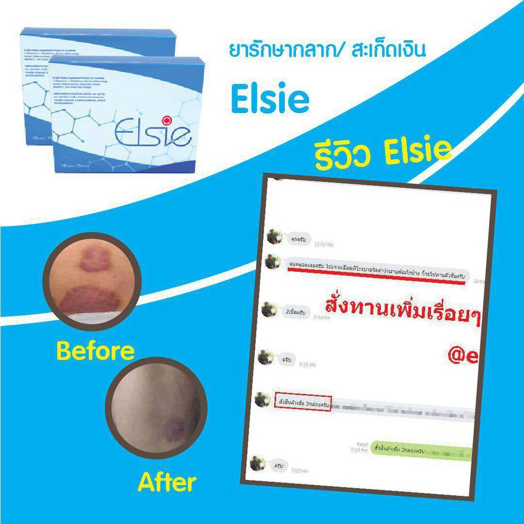 🔥 ELSIE ผลิตภัณฑ์บำบัดรักษาโรคสะเก็ดเงิน กำจัดเชื้อโรค ขับล้างสารพิษ ทำลายแบคทีเรีย ขจัดเซลล์ผิวตาย ☘️ ซื้อ 6 แถม 3 - รูปที่ 3