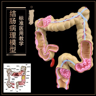 โมเดลหุ่นอนาโตมี่ Pathological Anatomy Model of Large Intestine Lesion Intestinal Disease Human Colon Lesion Model Human