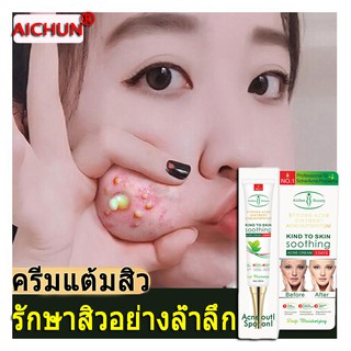 Aichun ครีมลดสิว รักษาสิวอย่างล้ำลึก(เซรั่มกำจัดสิว ครีมกำจัดสิว เซรั่มลดสิว ครีมลบรอยดำสิว เจลรักษาสิว ครีมรักษาสิว)