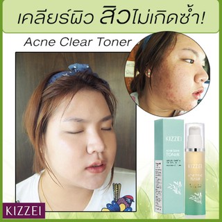 โทนเนอร์ ลดสิว สิวเสี้ยน กระชับรูขุมขน Kizzei  Acne Toner ลดสิวอุดตัน ลดสิวหน้าใส ลดหน้ามัน