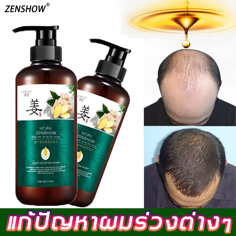 【การลดราคา】Zhenshow แชมพูแก้ผมร่วง ขิงแคร์คอมโบ300mlให้ผมหนาขึ้น（ป้องกันผมร่วง แชมพูขิง แชมพูสมุนไพร แชมพูป้องกันผมร่วง）