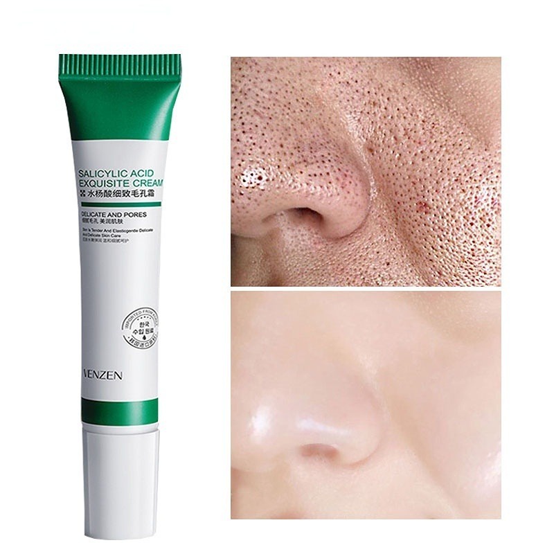 ครีมกรด Salcyclic ขนาด 20 มล . สําหรับการกําจัดรูขุมขน/Acne & Whitening/Anti-Aseity