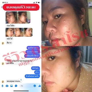 DR.SAROJ(ของแท้) ดร.สาโรช (Dr.Saroj) โลชั่นรักษาสิว สำหรับสิวอุดตัน (ทาทั่วหน้า) 60 ml.