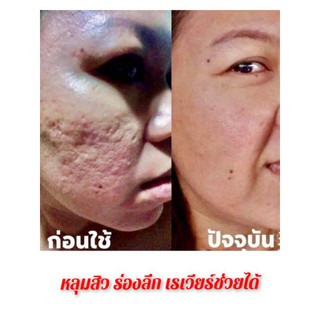 #ส่งฟรี ไม่ต้องใช้โค้ด(มีของแถมทุกการสั่งซื้อ)‼️ แพลนพลาเซนต้า ครีมบำรุงผิวหน้า หลุมสิว ริ้วรอย