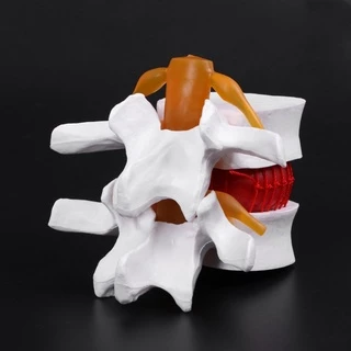 กายวิภาคของมนุษย์ Lumbar Disc Herniation Model การแพทย์ เรียนรู้ Aid Anatomy Instrume