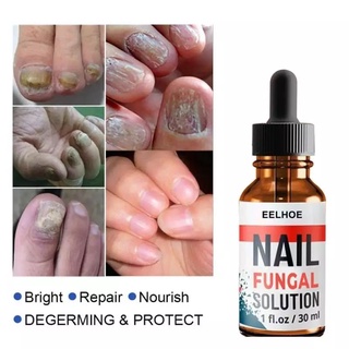 Nall Fungal วิธีแก้ปัญหาการรักษาเชื้อราเล็บ มือและเล็บเท้าที่แข็งแรงติดเชื้อรา