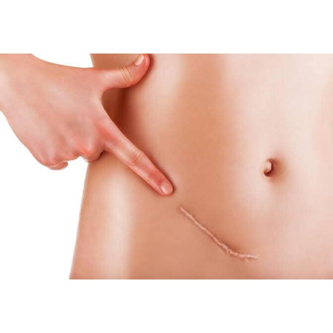 แผ่นซิลิโคน เจลชีท CICA-CARE ลดรอยแผลเป็น cica care สำหรับแผลเป็นที่มีลักษณะนูนแดง มี3ขนาด - รูปที่ 4