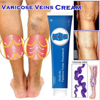ครีมรักษาเส้นเลือดขอด vasculitis แมงมุม