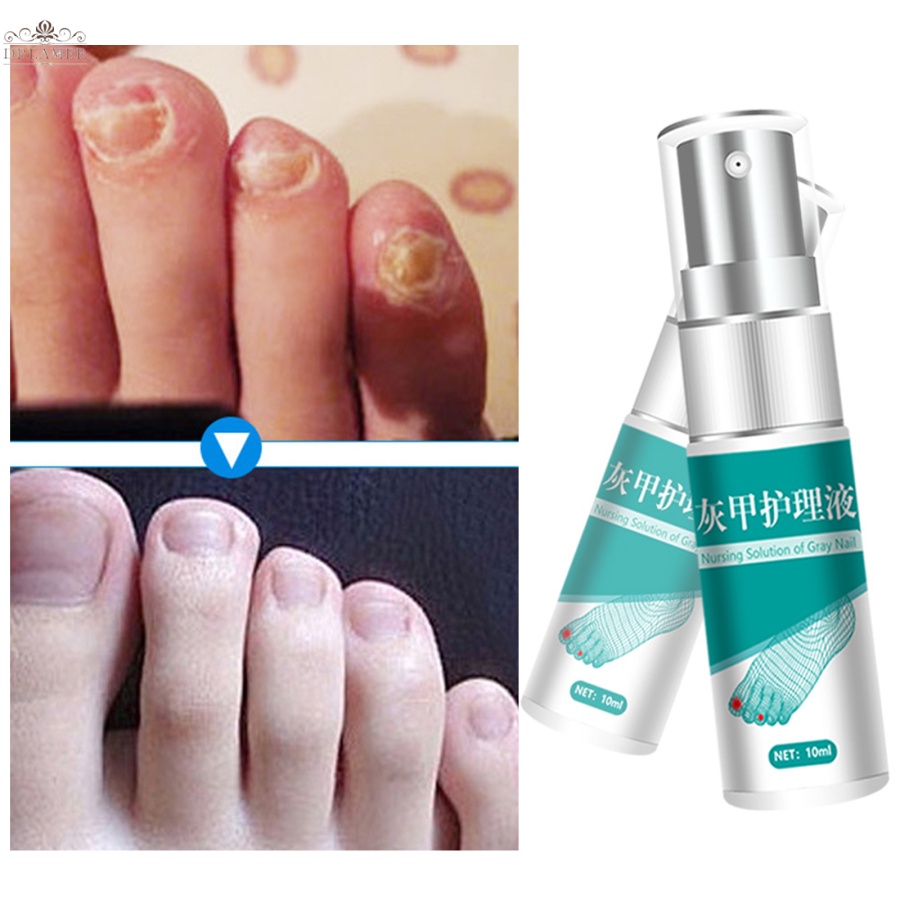 【DREAMER】Nail Fungal Treatment Essence Nail Foot Whitening Toe Nail Fungus Removal Gel Anti Infection Paronychia 10ml