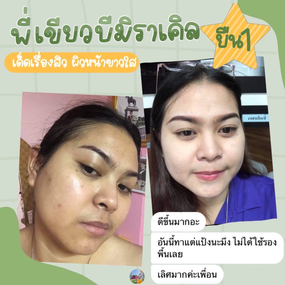 ครีมบีมิราเคิล (Bemiracle cream) ครีมเขียวรักษาสิวทุกชนิด ลดรอยด่างดำ หน้าขาวกระจ่างใส ราคา ถูกที่สุด ดีลบีเคเค แกลเลอรีภาพที่ 5