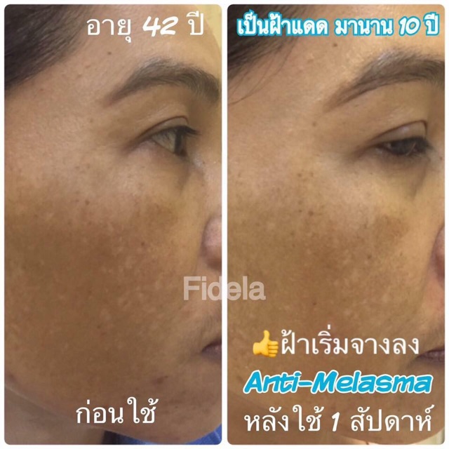 (แท้) Fidela Anti-Melasma Whitening Serum 30ml - katsupanee - ThaiPick