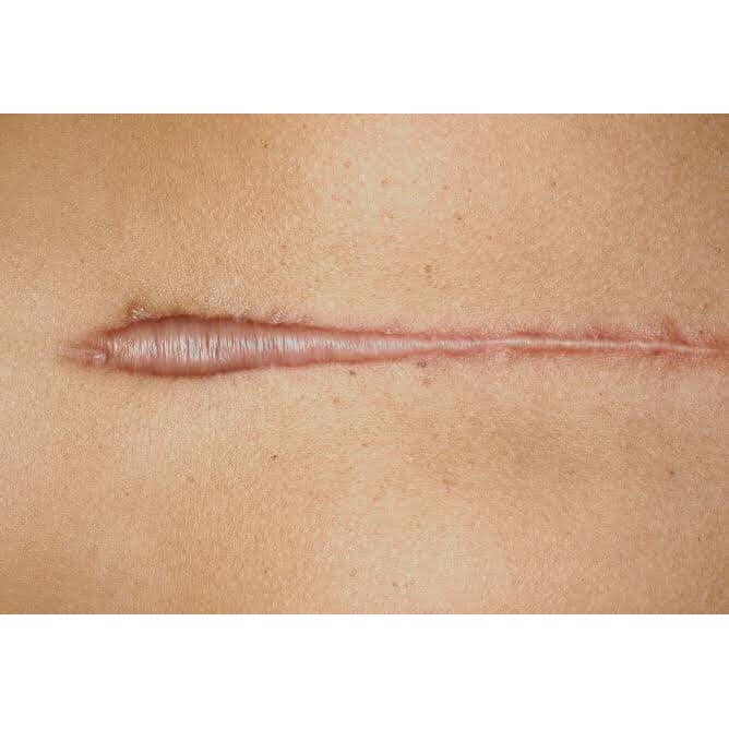 แผ่นซิลิโคน เจลชีท CICA-CARE ลดรอยแผลเป็น cica care สำหรับแผลเป็นที่มีลักษณะนูนแดง มี3ขนาด - รูปที่ 5