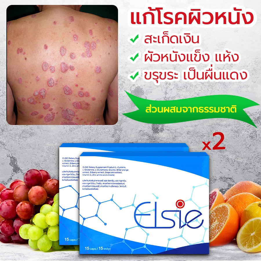 🔥 ELSIE ผลิตภัณฑ์บำบัดรักษาโรคสะเก็ดเงิน กำจัดเชื้อโรค ขับล้างสารพิษ ต้านไวรัส ทำลายแบคทีเรีย ขจัดเซลล์ผิวตาย ☘️ 2 กล่อง