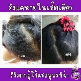 แชมพูเหาผู้ใหญ่ 200ml+ครีมนวด 50g+หวีสางสแตนเลส 1ด้าม แชมพูเหา สูตรสมุนไพร อ่อนโยน 5ขวบใช้ได้