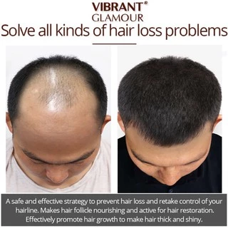 Hair Growth ยาปลูกผม น้ำยาปลูกผม บำรุงผม ปลูกผม เซรั่มปลูกผม ป้องกันผมร่วง เพื่อผมหนา ผมเงา ผมดกกำ บำรุงรากผม