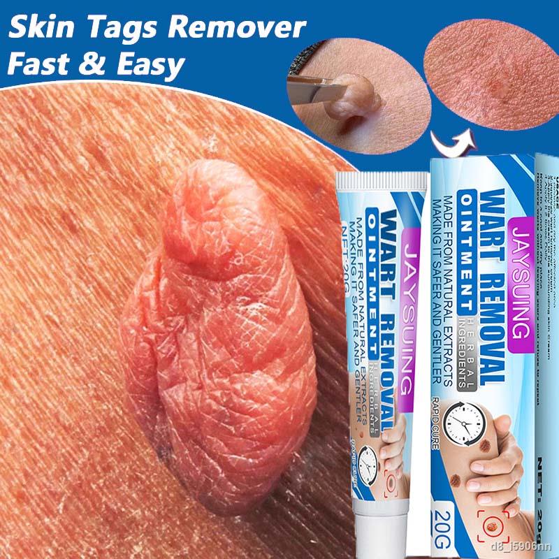 Wart Removal Cream Skin Tags Treatment Safe Painless Herbal Antibacterial Ointment Foot Corn Removal