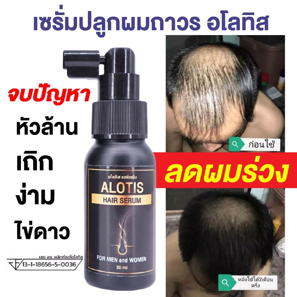 เซรั่มปลูกผม Alotis อโลทิส ยาปลูกผม ลดผมร่วง ลดผมบาง หัวล้าน หัวเถิกไข่ดาว รากผมแข็งแรง เห็นผลจริง ม