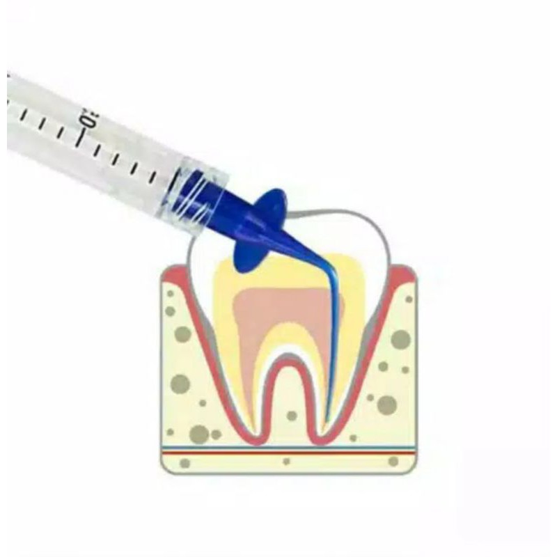 TIP SUCTION ENDO / ENDO IRRIGATION / TIP CALXIPEX