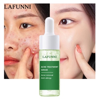 LAFUNNI Acne Treatment Face Serum Acne Pimple Removal Repair Skin Facial Essence Skin Care