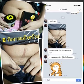 โปรตีนบัวหิมะ แก้ผดผื่น แก้รอยแตกลาย ใช้ได้ตั้งแต่เด็ก3ขวบ