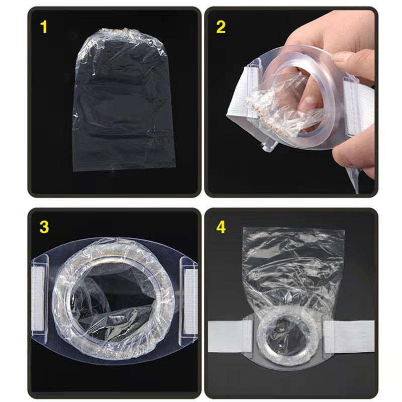 2pcs Colostomy Ostomy เข็มขัด/Ostoma เอวซิลิโคน Stoma วงกลมเข็มขัด + 80 ชิ้น Ostomy กระเป๋าหลังจาก Coลอสโตmy Iliostomy กระเป๋า - รูปที่ 3