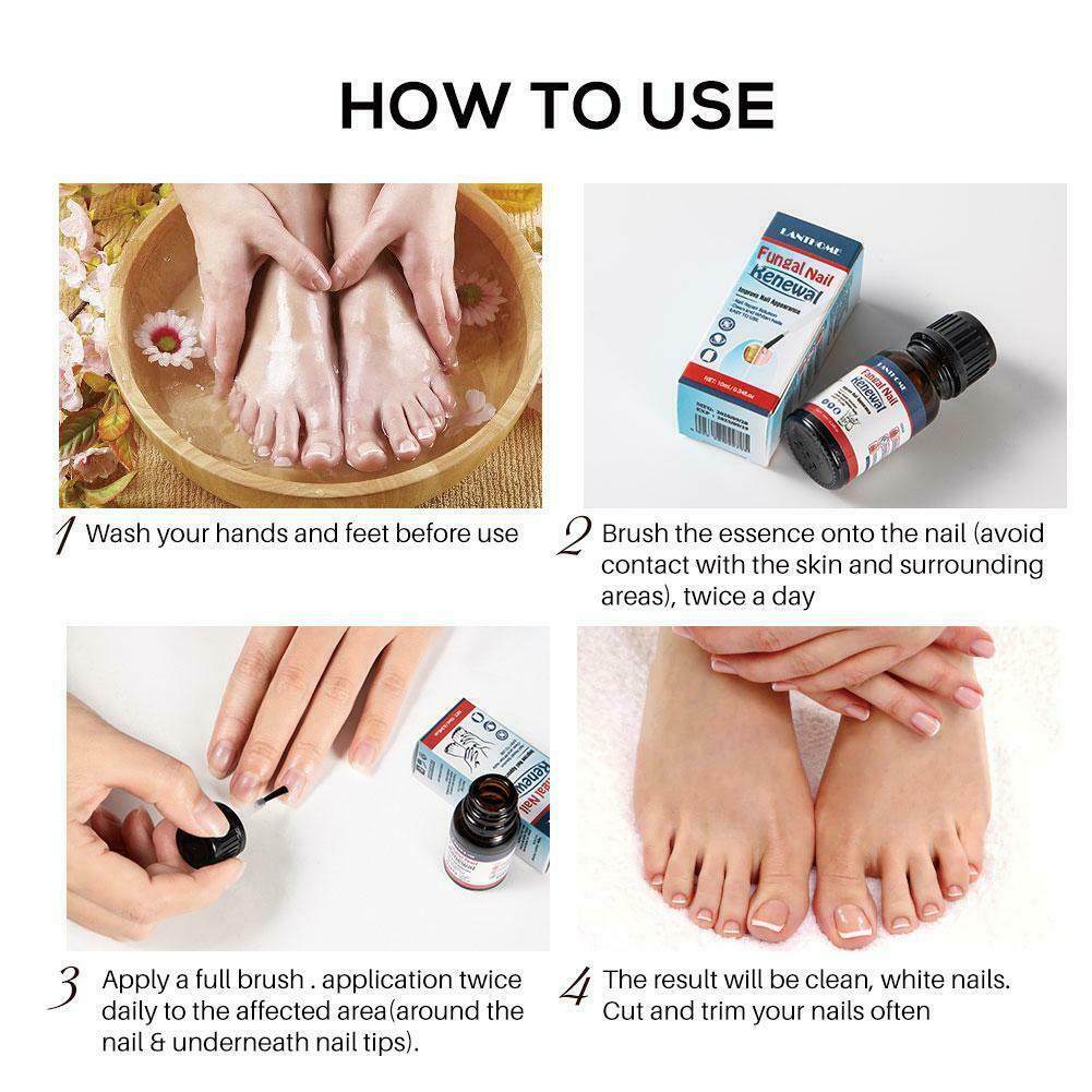 LANTHOME 10ml fungal nail repair nourish fungal nail to anti-infection hand treatment foot G9O6