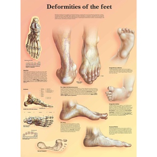 โปสเตอร์ผ้าไหม พิมพ์ลาย Deformity of the Human Feet สําหรับตกแต่งบ้าน