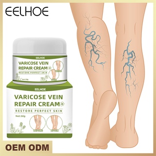 Eelhoe Vein Repair Cream บรรเทาอาการปวดขาเส้นเลือดขอดนูนโดยการขุดลอก Veemm หลอดเลือดดำ