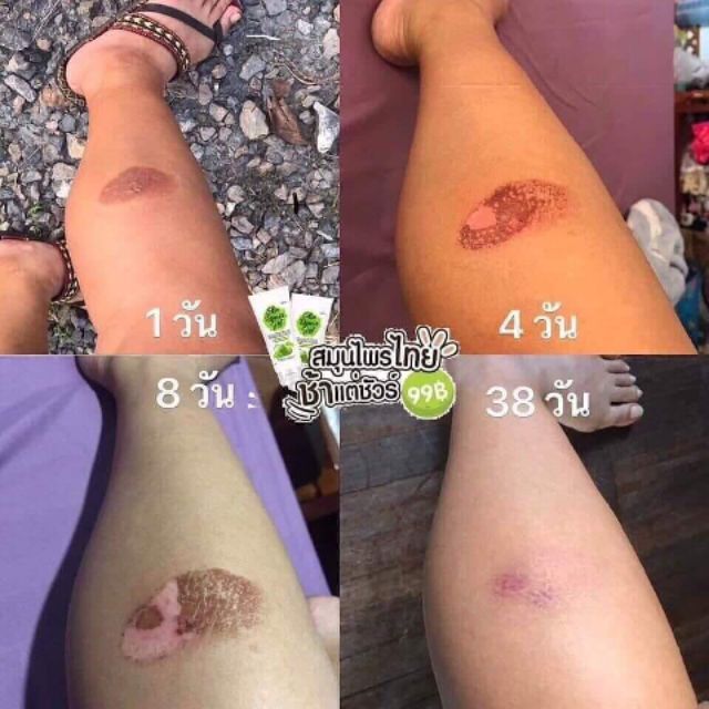 #เจลซ่อมผิว Erika #เจลซ่อมผิว