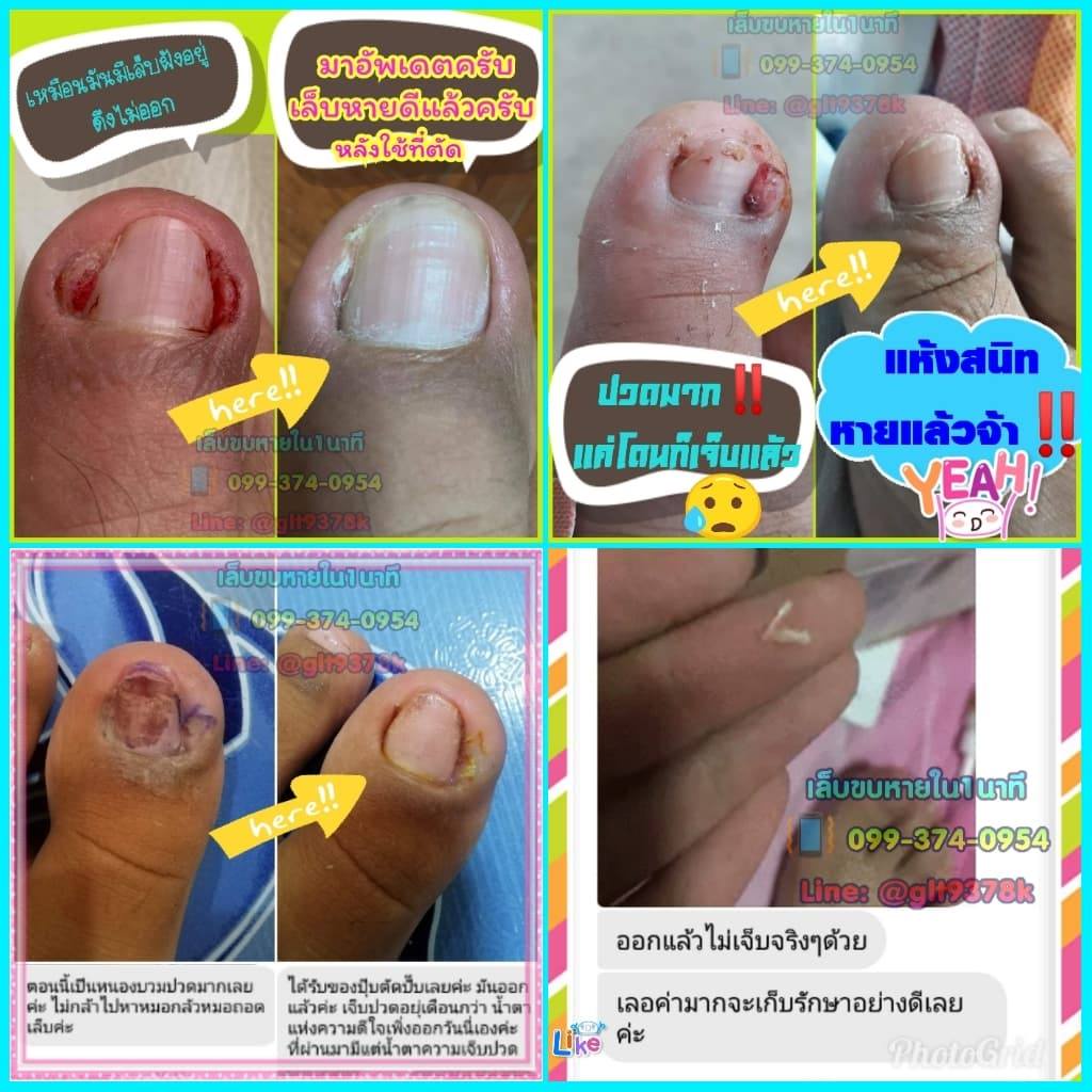 แซะซอกเล็บ ตัดเล็บขบ แบบเปลี่ยนใบมีด เลาะเล็บขบสำหรับมืออาชีพ - รูปที่ 5