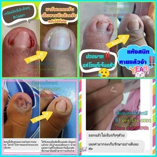 แซะซอกเล็บ ตัดเล็บขบ แบบเปลี่ยนใบมีด เลาะเล็บขบสำหรับมืออาชีพ