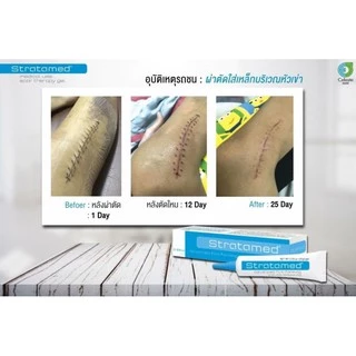 Strataderm gel / Stratamed / Stratacel / Stratamark แผลสด แผลเป็น แผลนูน ผ่าตัด ศัลยกรรม แตกลาย