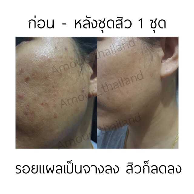AMOUR Acne Lotion for acne ราคา ถูกที่สุด ดีลบีเคเค แกลเลอรีภาพที่ 7