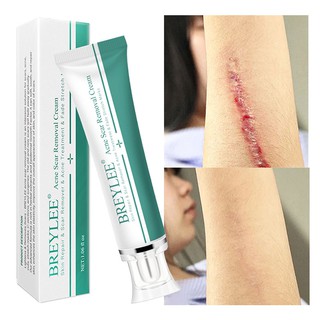 BREYLEE Acne Scar Removal Cream ครีมกำจัดรอยแผลเป็นจากสิว